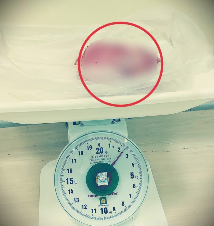 Cắt khối u xơ nặng 2.5kg tương đương thai 30 tuần cho bệnh nhân 34 tuổi